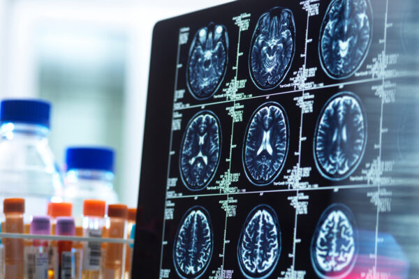 MimiVax Announces Data Cutoff for Phase 2b SURVIVE Trial of SurVaxM in Newly Diagnosed Glioblastoma