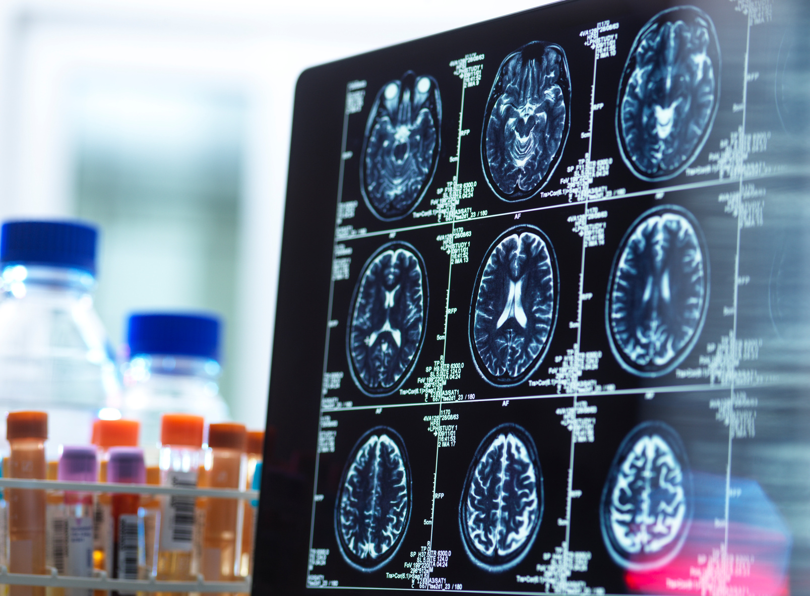 Read more about the article MimiVax Announces Data Cutoff for Phase 2b SURVIVE Trial of SurVaxM in Newly Diagnosed Glioblastoma