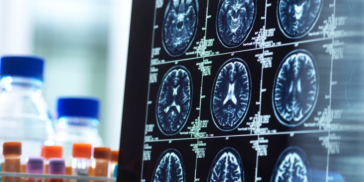 MimiVax Announces Data Cutoff for Phase 2b SURVIVE Trial of SurVaxM in Newly Diagnosed Glioblastoma